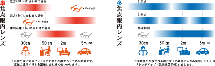 多焦点眼内レンズの（老眼治療）について